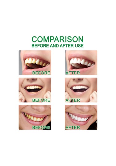 Mufunye Eelhoe 1 Adet Diş Beyazlatma Kalemi Parlatıcı Alet Seyahat/gezi/ev Günlük Kullanım İçin Taşınabilir