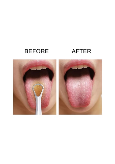 Vkemall Paslanmaz Çelik Dil Kazıyıcı 2 Li Paket, Ergonomik Tasarım, Ağız Hijyeni İçin Dayanıklı Ve Yeniden Kullanılabilir