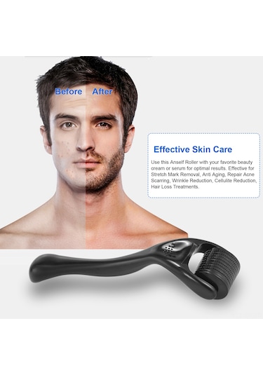 Vkemall 0.25mm 540 Titanyum Sakal Rulosu - Siyah Mikro İğneli Yüz Bakım Aracı