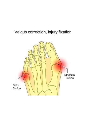 5 Çift Giyilebilir Ayakkabı Büyük Ayak Valgus Düzeltici Parmak