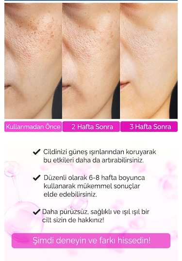 Devida Sivilce Karşıtı Siyah Nokta Akne Temizleyici Serum Elixir Series A260