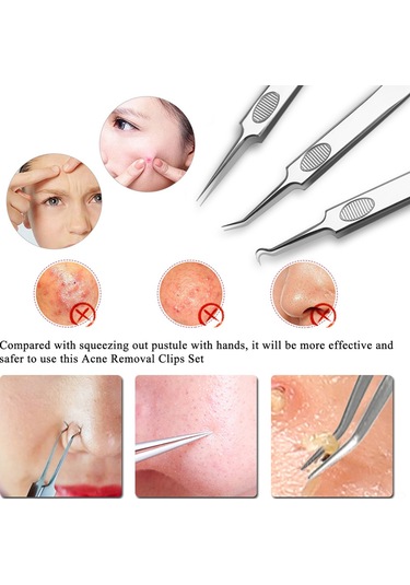 Vkemall 3'lü Paslanmaz Çelik Siyah Nokta Ve Sivilce Temizleme Seti - Cilt Bakımı Ve Hijyen İçin Profesyonel Araçlar