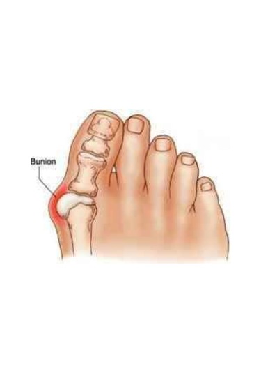 Ayak Bunyon Başparmak Kemik Koruyucu Makaralı Yastık 2'li Set