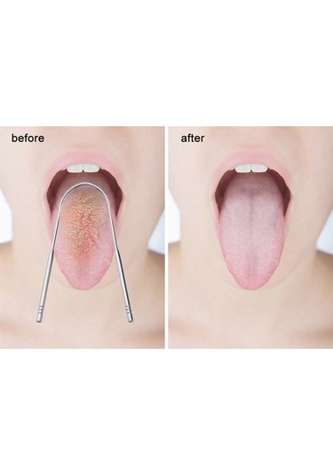 Vkemall Paslanmaz Çelik Dil Kazıyıcı 2 Li Paket, Ergonomik Tasarım, Ağız Hijyeni İçin Dayanıklı Ve Yeniden Kullanılabilir