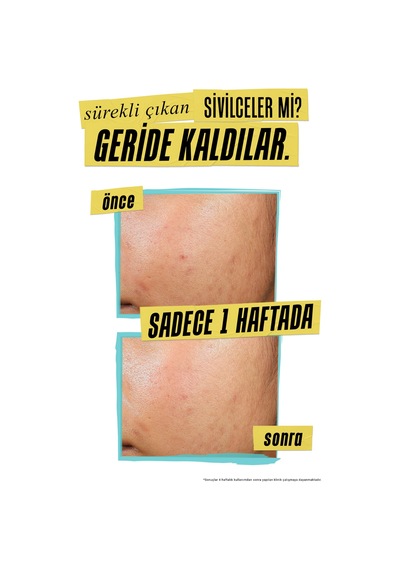 Sivilce Görünümünü Azaltan Ve Önleyen, %1,2 Salisilik Asit Ve %2 Niasinamid İçeren Bakım Kremi.60ml