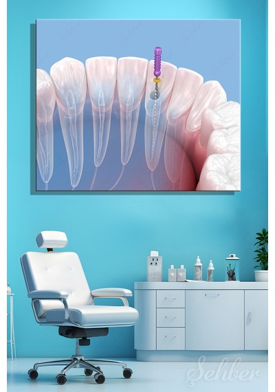 Endodontik Kök Kanal Tedavi Sürecinin 3d Tıbbi İllüstrasyonu Yatay Kanvas Tablo Tekli 3746 Çok Renkli
