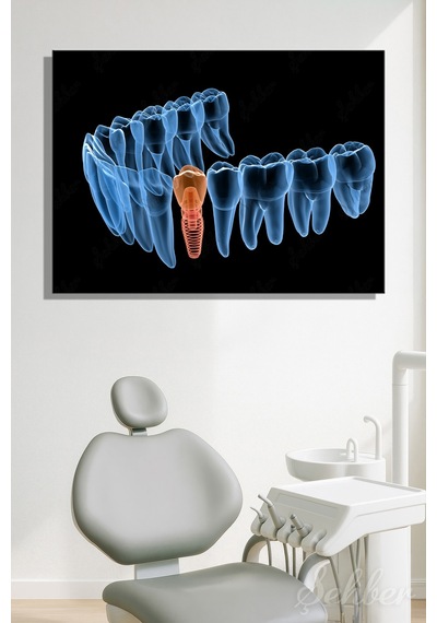 Diş İmplantı Yapay Diş Kökü Tıbbi Ve Anatomik 3 Boyutlu İllüstrasyon Yatay Kanvas Tablo Tekli 3659
