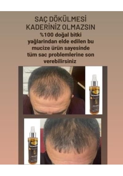 Dökülme Önleyici Saç Bakım Yağı Saç Çıkarıcı  Kök Uyarıcı Saçları