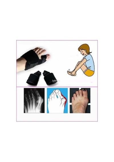 Halluks Valgus Gece Ateli Ayak Baş Parmak Kemik Çıkıntısı