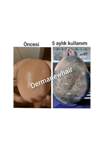 Ayrex Dermanew Saç Büyüme Serumu, Hair, 50 Ml, 10'lü Set - Hair