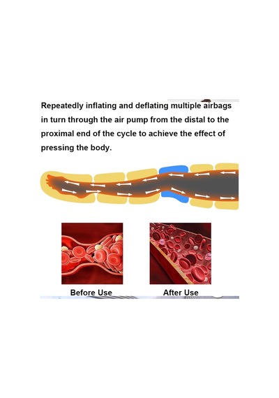 6/8 Hava Odacıklı Joyfitness Lenfatik Drenaj Cihazı, Lipedema Masajı, Lipedema Tedavisi İçin Hava Sıkıştırmalı Bacak Masajı, Lipedema, Su Tutma Ve Şişlik İçin İdeal