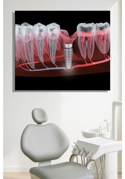 Dental İmplant Tıbbi 3d Çizim Yatay Kanvas Tablo Tekli Ağız Diş Sağlığı Dişçi Poliklinik Hastane 3497