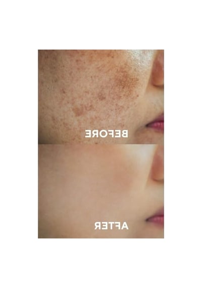 30 Ml Leke Karşıtı Cilt Serumu İle Cilt Tonu Eşitleme