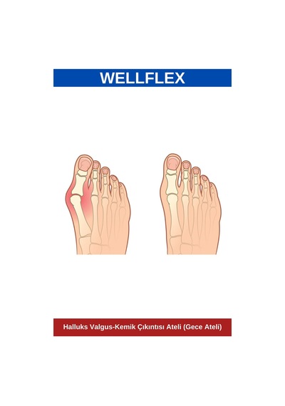 Halluks Valgus - Kemik Çıkıntısı Ateli Gece Ateli