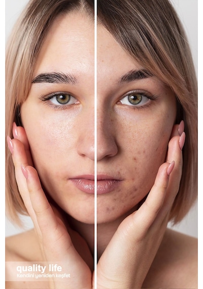 Quality Life Akne Serumu Sivilce Siyah Nokta Leke Akne Karşıtı Cilt Serumu 30 ML