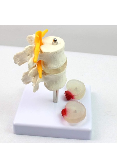 Fıtık Ve Disk Kayması Olan 2 Lomber Vertebralı Omurga Modeli - Om