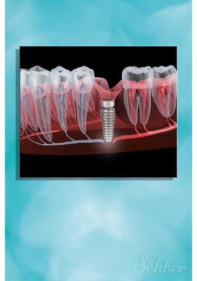 Dental İmplant Tıbbi 3d Çizim Yatay Kanvas Tablo Tekli Ağız Diş Sağlığı Dişçi Poliklinik Hastane 3497