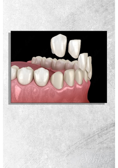 Diş Kaplama Veneer Uygulaması Sürecinin 3 D Aşamaları Tıbbi İllüstrasyon Yatay Kanvas Tekli Tablo 3671