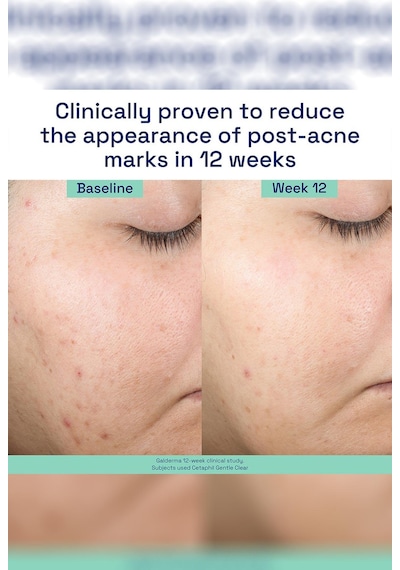 Cetaphil Gentle Clear Akne Sonrası Leke Karşıtı Onarıcı Yüz Serumu 30ml