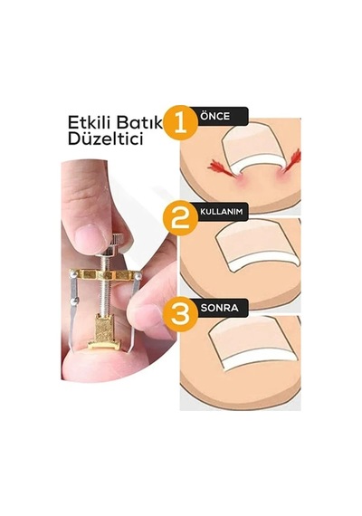 Batık Tırnak Çıkartıcı Çelik Batan Tırnağı Düzeltme Aparatı Düzeltici Aleti Çıkarıcı Aparat