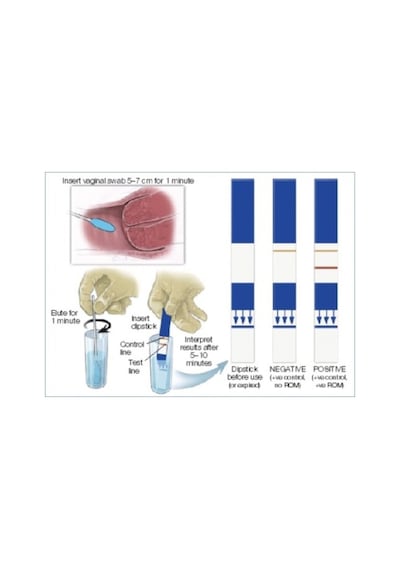 Amnisure Fetal Membran Yırtığı Testi