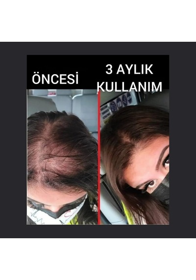 Saç Büyüme Serumu, Hair, 50 Ml, 10'lü Set - Hair