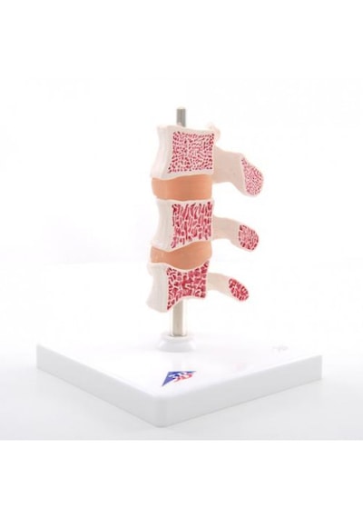 Osteoporoz Modeli, 3 Omur 01