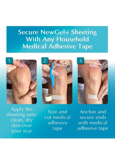 Newgel+ C-section Strips - Sezaryen Sonrası Silikon Yara İzi Bandı 5.1cm X 20cm - Şeffaf