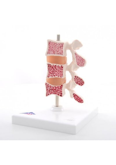 Osteoporoz Modeli, 3 Omur 01