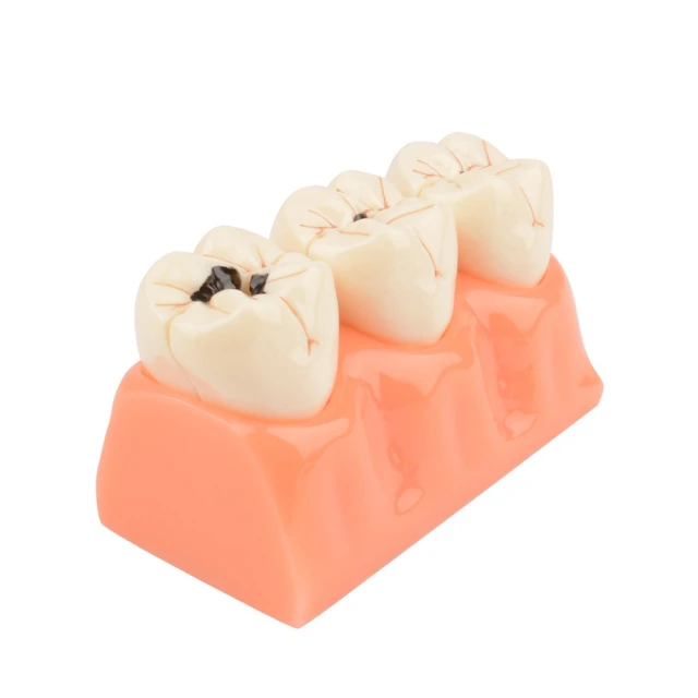 Diş Çürüğü Gelişim Modeli - Öğretici Amaçlı 4 Kat Diş Çürüğü - Diş Maketi - 11 X 6 X 7 Cm 01