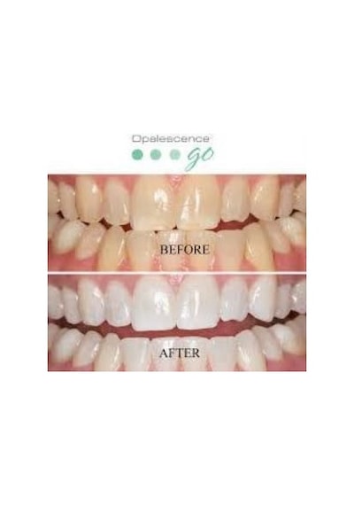 Opalescence Ultradent Go Hazır Kalıp Nane Diş Beyazlatma 8'li