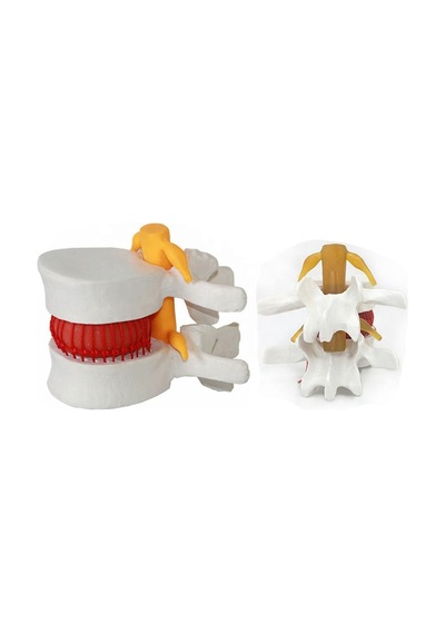 Disk Hernisi Fıtık Maketi Model 16