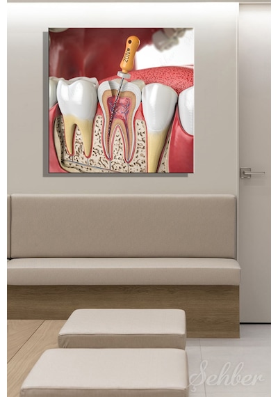 Endodontik Tedavi Kanal Tedavisi Prosedürü 3d Tıbbi İllüstrasyon Yatay Kanvas Tablo 3862 Çok Renkli