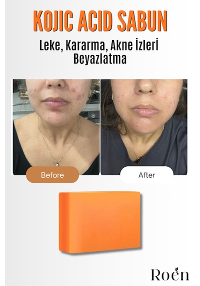 Doğal Kojik Asit Sabunu, Cilt Beyazlatıcı, Leke Giderme, Kararma, Akne, Güneş Lekeleri 110gr Kokusuz