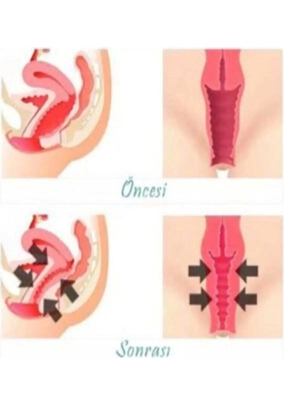 Süper Vagitight Kadınlar Için Genital Bölge Krem 100 Ml X 2 Adet