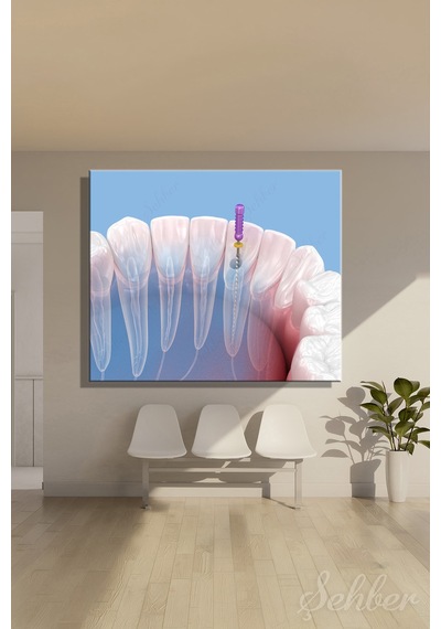 Endodontik Kök Kanal Tedavi Sürecinin 3d Tıbbi İllüstrasyonu Yatay Kanvas Tablo Tekli 3746 Çok Renkli