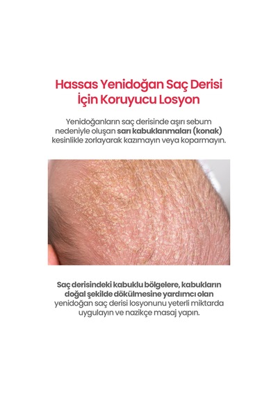 Bebeklere&yenidoğanlara Özel Konak Karşıtı Saç Derisi Losyonu Atopalm Newborn Scalp Lotion