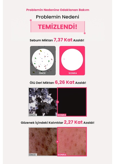 Akneye Eğilimli Ciltler İçin Yağ-nem Dengesi Sunan Yüz Temizleme Jeli Zeroıd Pimprove Gel Cleanser
