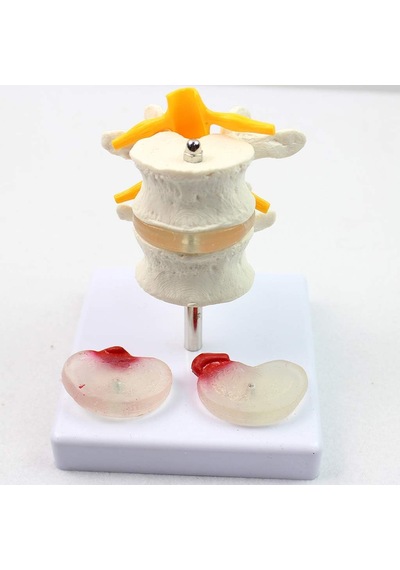 Fıtık Ve Disk Kayması Olan 2 Lomber Vertebralı Omurga Modeli - Om