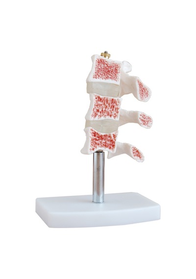Osteoporoz Kesiti Modeli