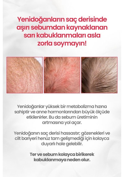 Bebeklere&yenidoğanlara Özel Göz Yakmayan Konak&sebum Karşıtı Şampuan Atopalm Newborn Scalp Shampoo