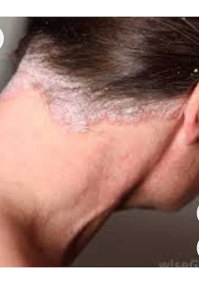 Cilton E Derm Özel Bakim Kremi 50 Ml