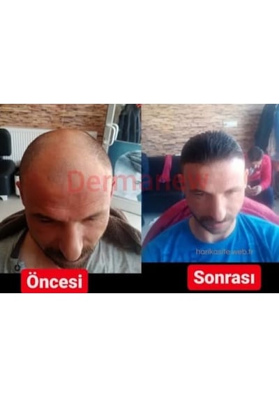 Ayrex Dermanew Saç Büyüme Serumu, Hair, 50 Ml, 10'lü Set - Hair