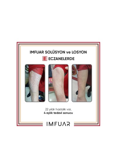 Egzama/sedef/mantar/seboreik Dermatit/rozasea Saç Ve Deri Solüsyonu 50 Ml