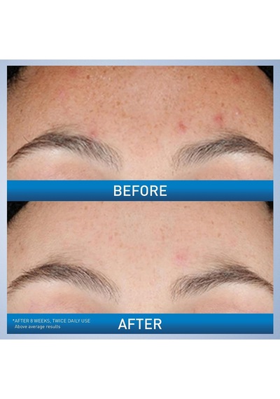 "akne Sonrası İşaretler Ve Cilt Dokusu İçin Retinol Serumu Gözenek Rafine Etme, Yeniden Yüzey, Retinol İle Aydınlatıcı Yüz Serumu 1 Oz"