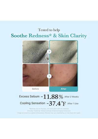 Azelaic Acid Niacinakarın Bölgesi Clarifying Toner Troubled Skin Care, Purifying & Calming İçin İdeal %4 Azelaik A
