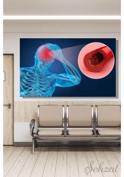 Yatay Tekli Kanvas Duvar Tablosu Nöroloji Doktor Klinik Hastane Beyin Damar Cerrahı Felç İnme Pıhtı 3d Çok Renkli
