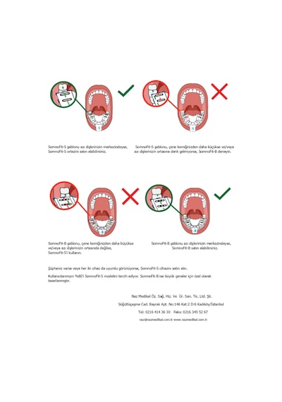 Somnofit-b, Mandibular Alt Çene İlerletme Aparatı