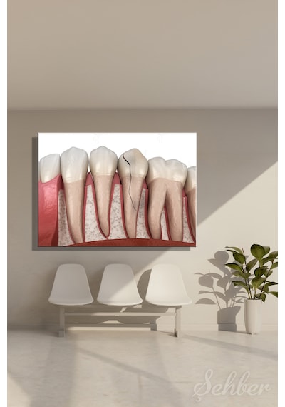 Diş Eti Çene Kemiği Dikey Çatlak Diş Krack Diş 3d Tıbbi İllüstrasyon Kanvas Tablo Yatay Tekli 3669