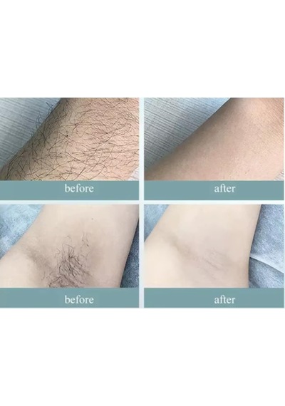 Acısız Ipl Buz Lazer Epilasyon Cihazı 999.999 Flaş Atım Tüm Vücut - Yüz Sku: Smg8690010442666